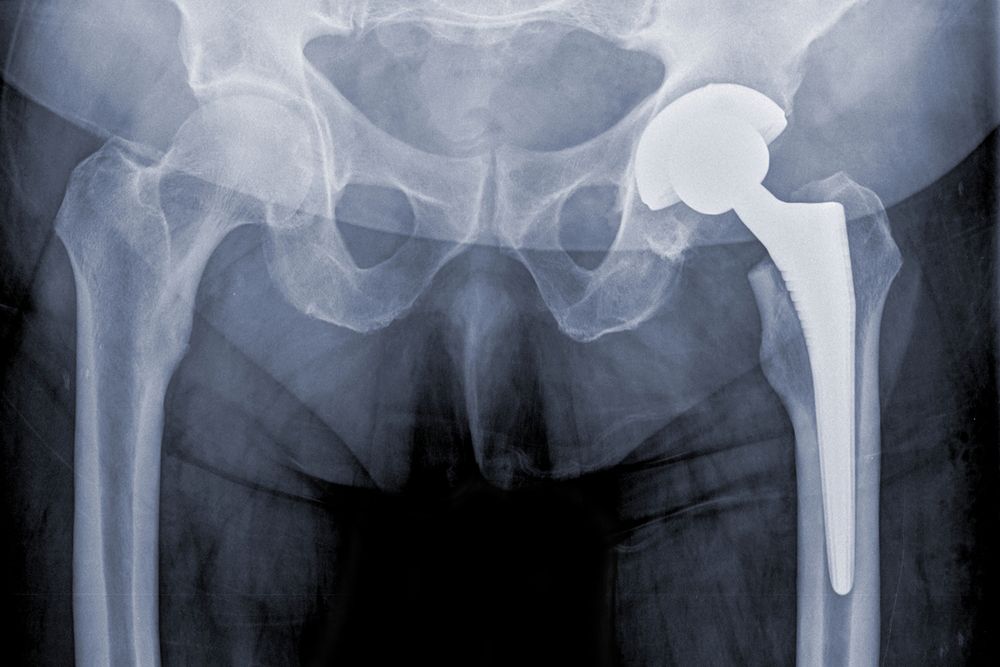 An x-ray of a defective hip replacement system